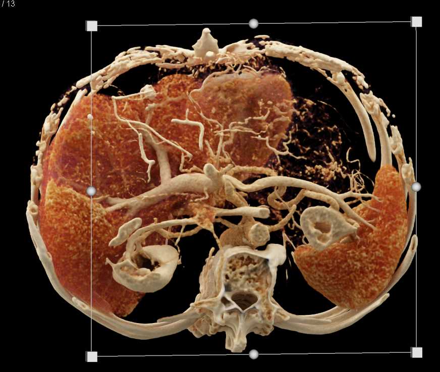 Carcinoma Body of the Pancreas with Cinematic Rendering - CTisus CT Scan