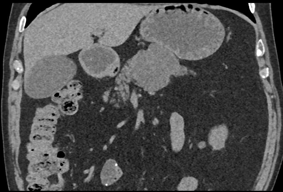 Serous Cystadenoma Pancreas with Dilated Pancreatic Duct - CTisus CT Scan