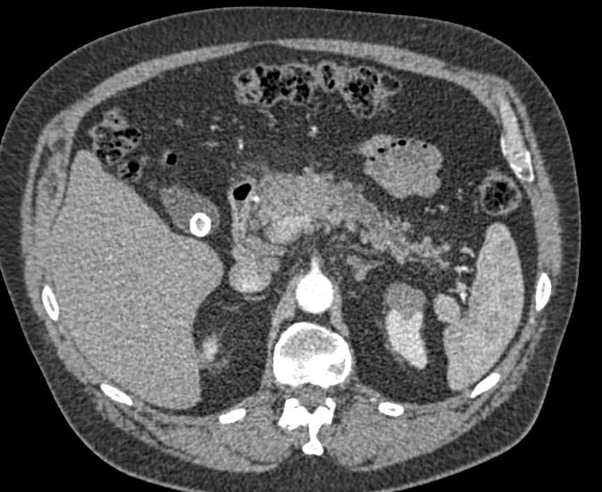 Subtle Adenocarcinoma Body of Pancreas with Dilated Pancreatic Duct - CTisus CT Scan