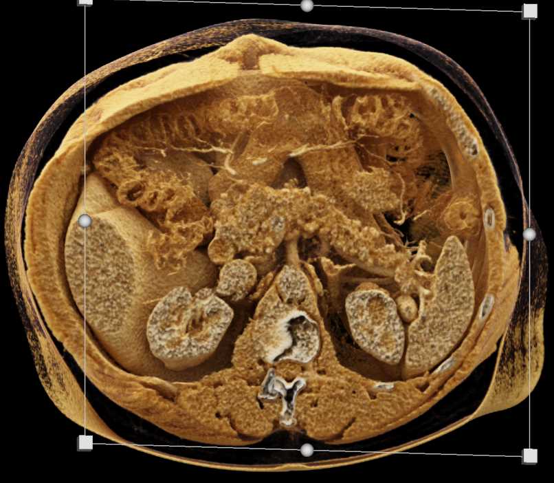 Subtle Adenocarcinoma Body of Pancreas with Dilated Pancreatic Duct and Cinematic Rendering - CTisus CT Scan