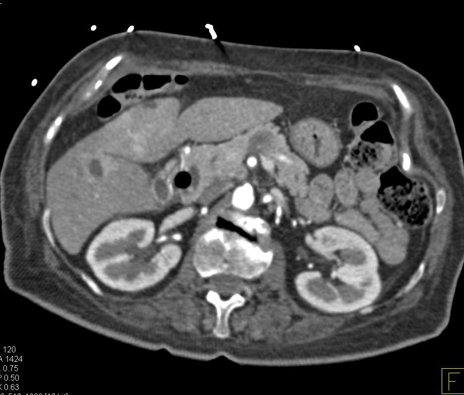 Adenocarcinoma Body of the Pancreas with Liver Metastases - CTisus CT Scan