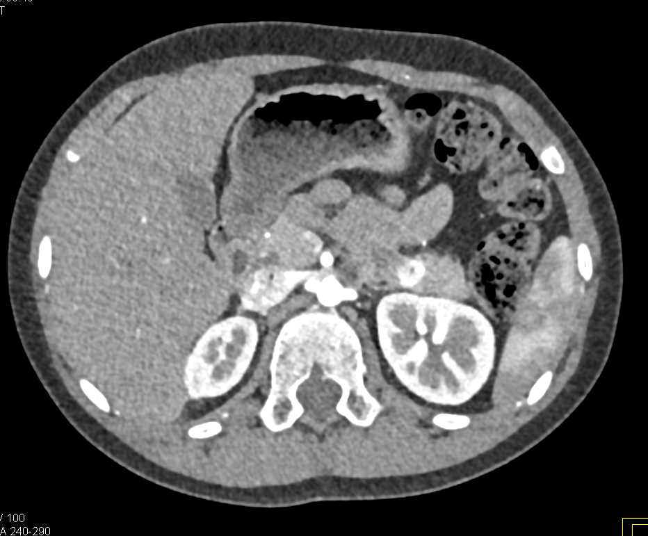 Neuroendocrine Tumor in the Tail of the Pancreas - CTisus CT Scan