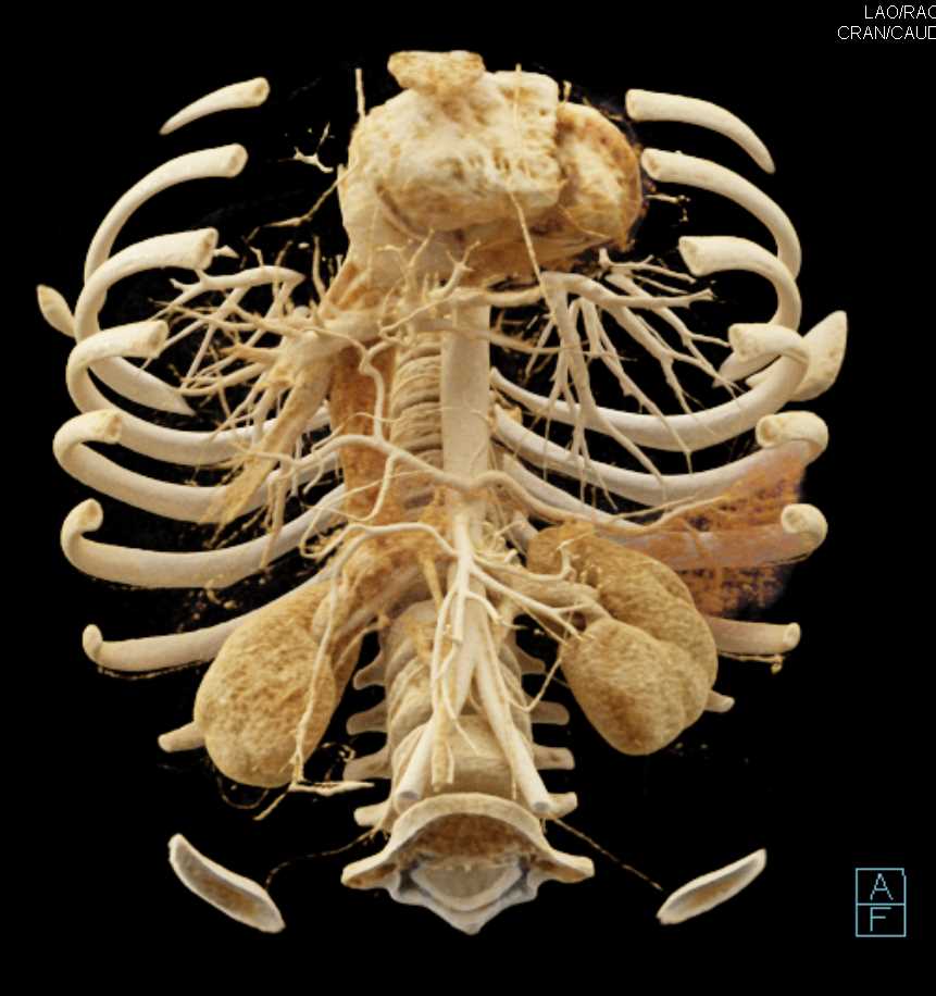 Cinematic Rendering of Pancreatic Cancer - CTisus CT Scan