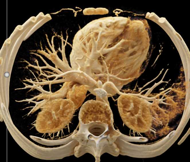 Neuroendocrine Tumor 1cm Tail of Pancreas on Cinematic Rendering - CTisus CT Scan