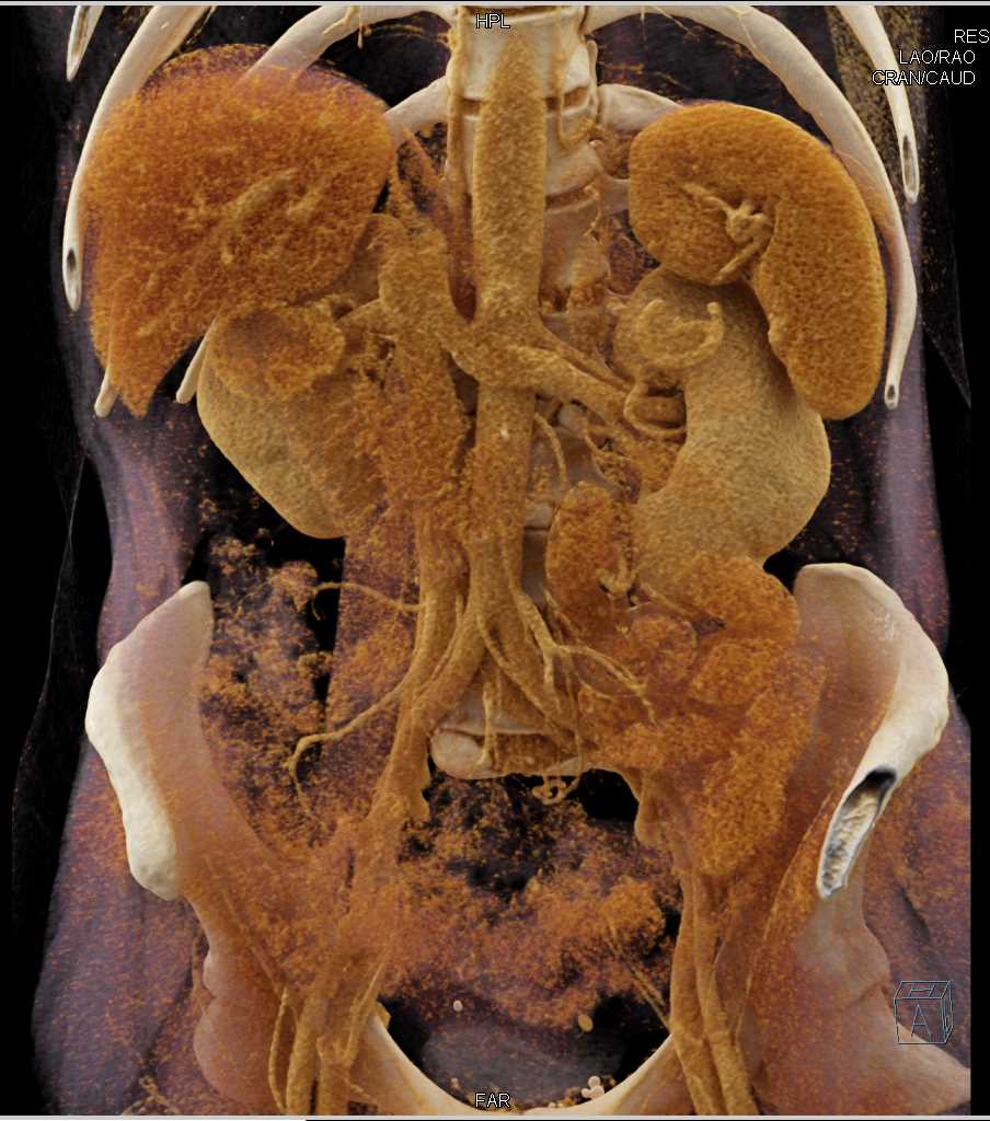 Cinematic Rendering of Pancreatic Cancer - CTisus CT Scan