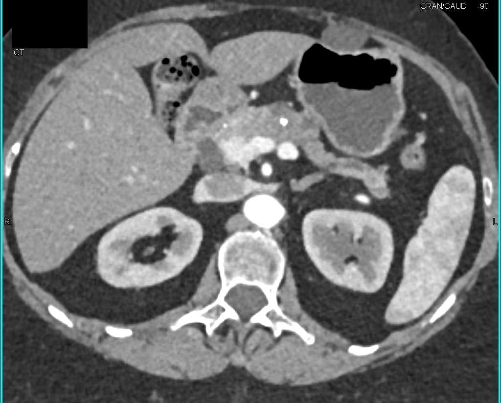 Adenocarcinoma Body of the Pancreas - CTisus CT Scan