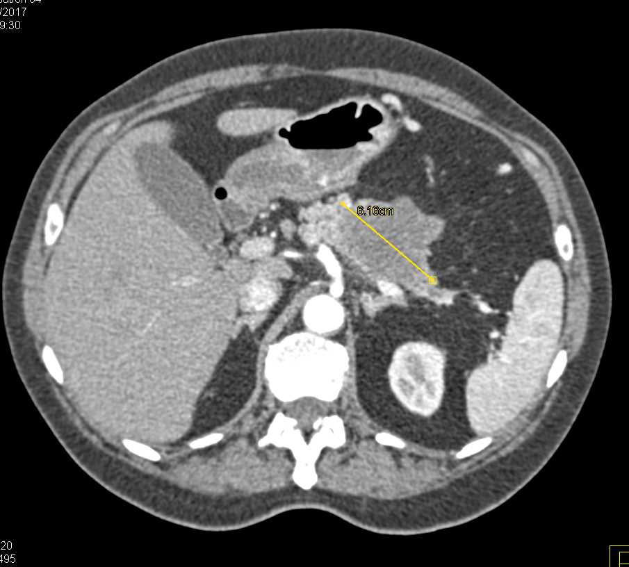 Carcinoma Body of the Pancreas - CTisus CT Scan