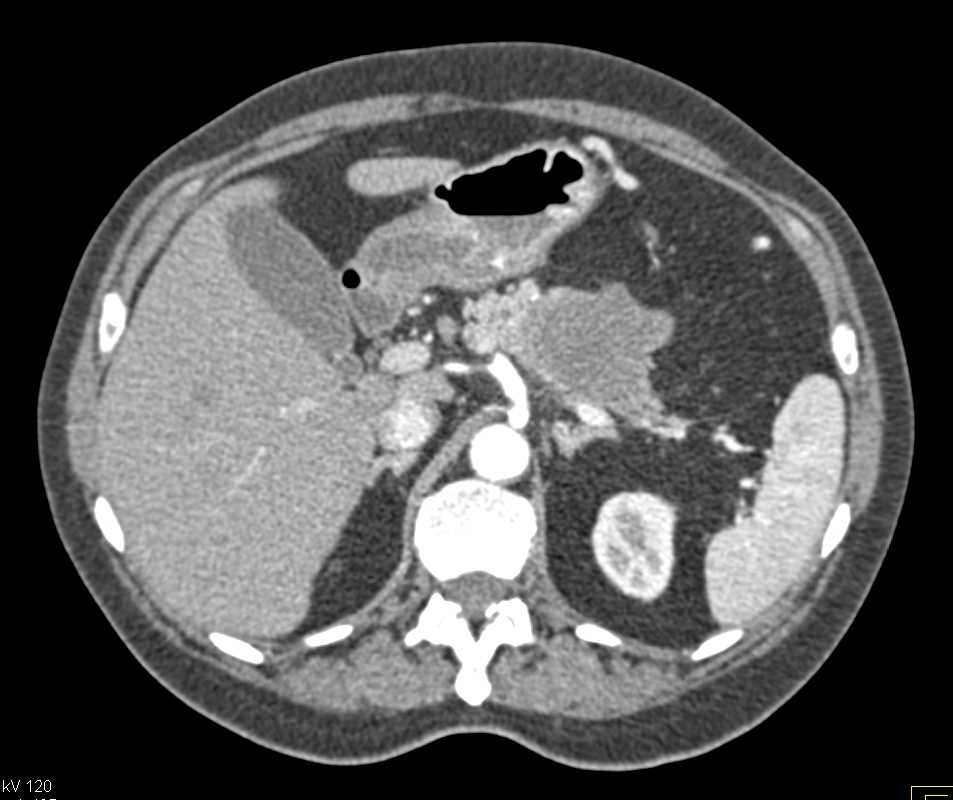 Carcinoma Body of the Pancreas - CTisus CT Scan