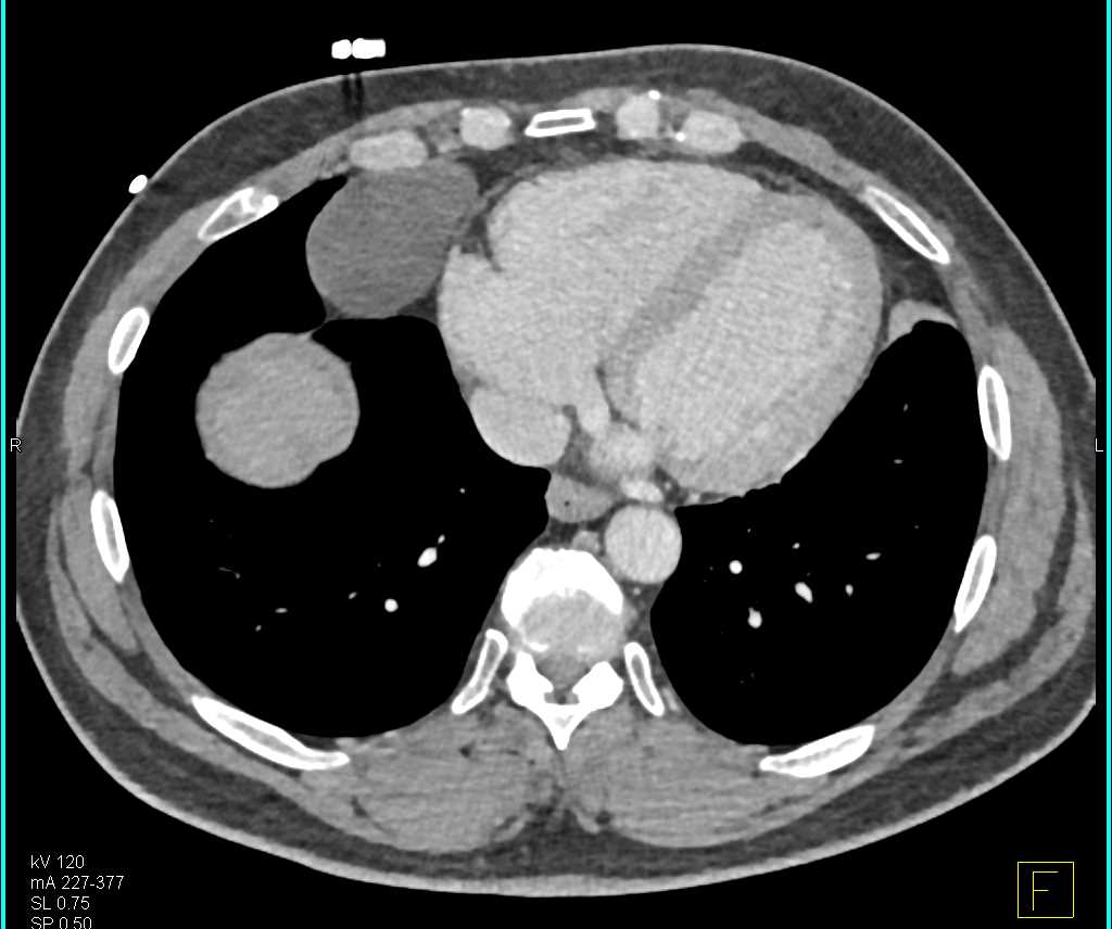 Pericardial Cyst - CTisus CT Scan