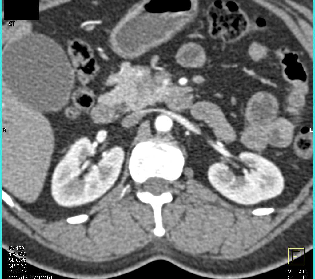 1cm Carcinoma Head of Pancreas - CTisus CT Scan