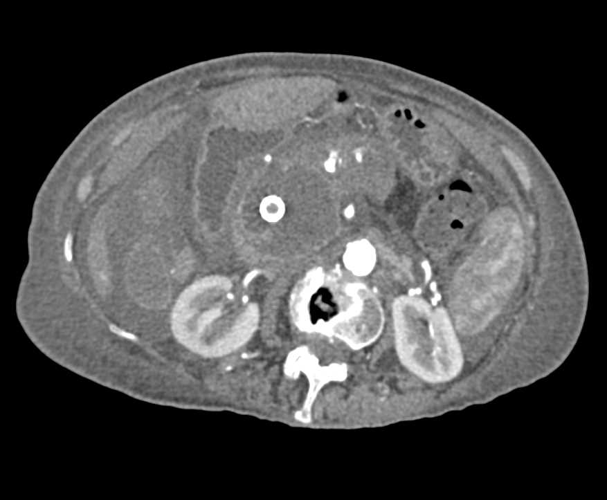 Pancreatic Cancer with Vascular Encasement - CTisus CT Scan