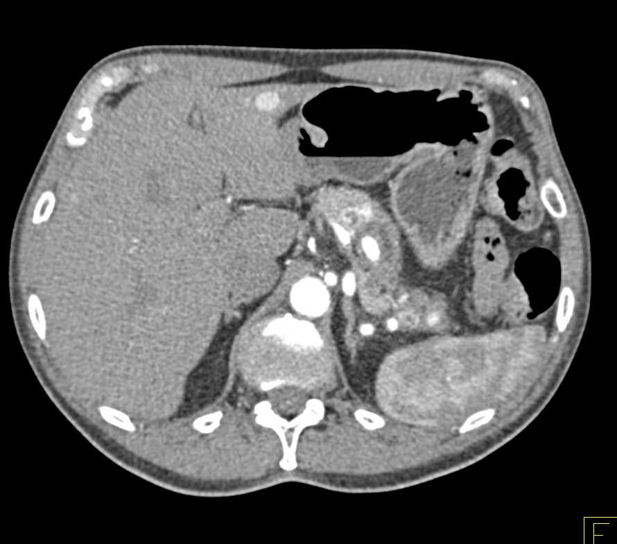 Renal cell carcinoma Metastatic to the Pancreas - CTisus CT Scan