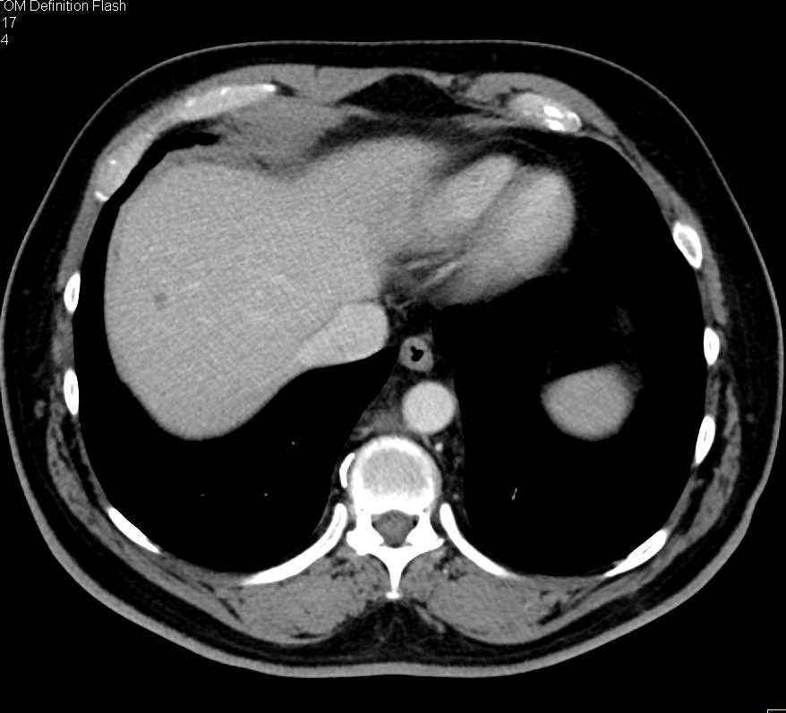 Subtle Pancreatic Adenocarcinoma - CTisus CT Scan