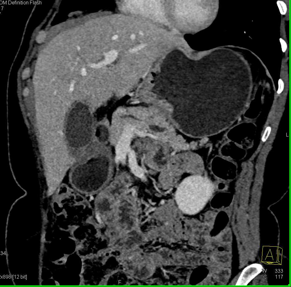 Hypodense Pancreatic Adenocarcinoma with Pancreatic Duct Cutoff Sign - CTisus CT Scan