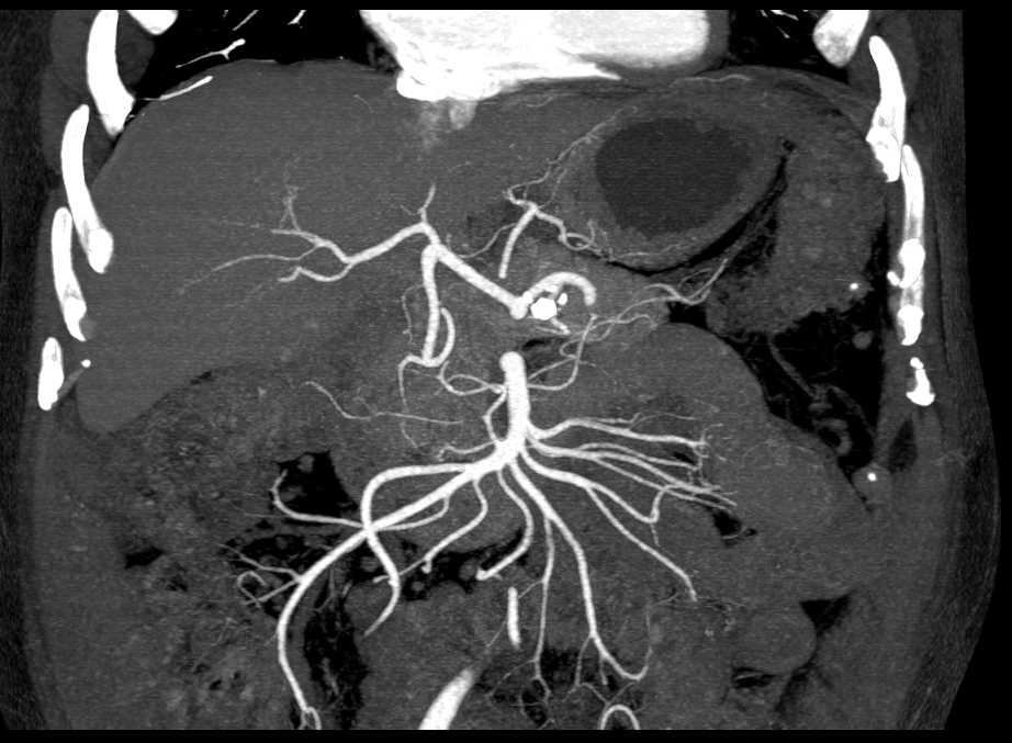 Neuroendocrine Tumor in the Body of the Pancreas - CTisus CT Scan