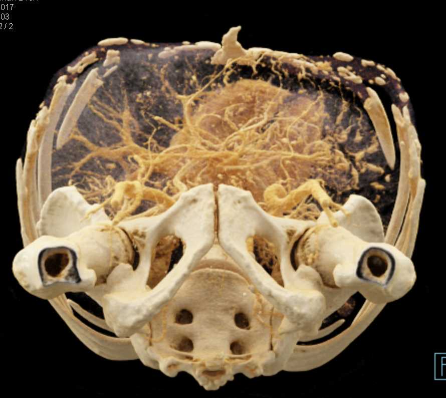 Neuroendocrine Tumor in the Body of the Pancreas with Cinematic Rendering - CTisus CT Scan