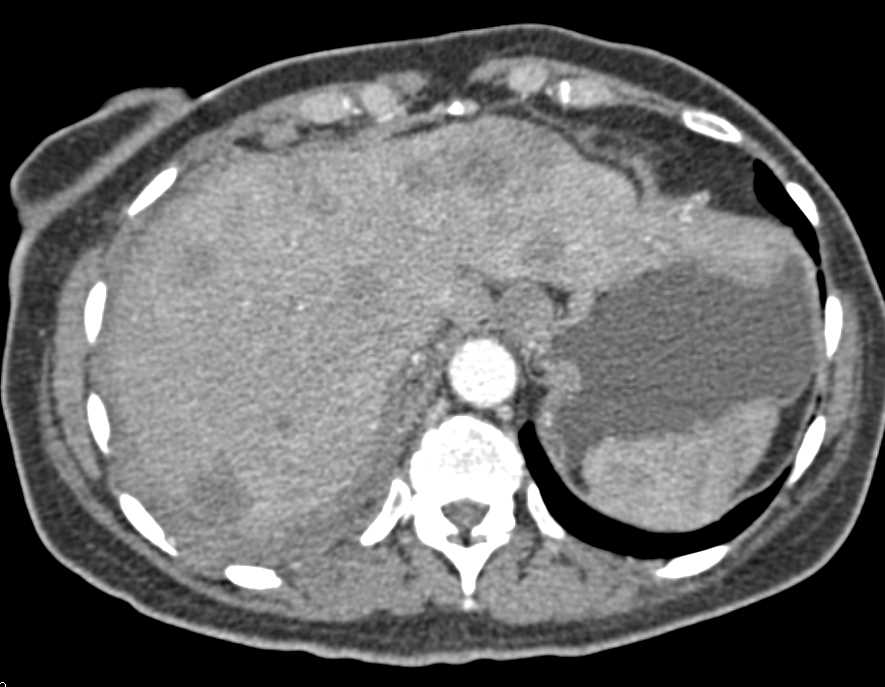 Adenocarcinoma Tail of Pancreas with Liver Metastases - CTisus CT Scan