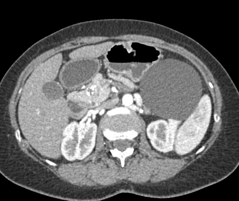 1cm Neuroendocrine Tumor Head of Pancreas - CTisus CT Scan