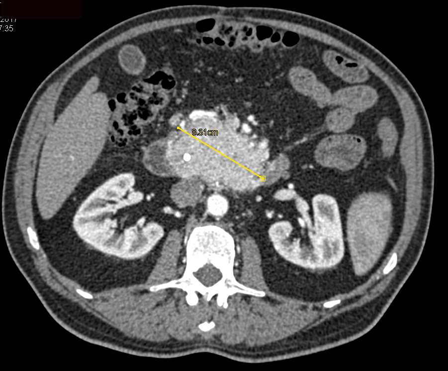 Neuroendocrine Tumor Head of Pancreas - CTisus CT Scan