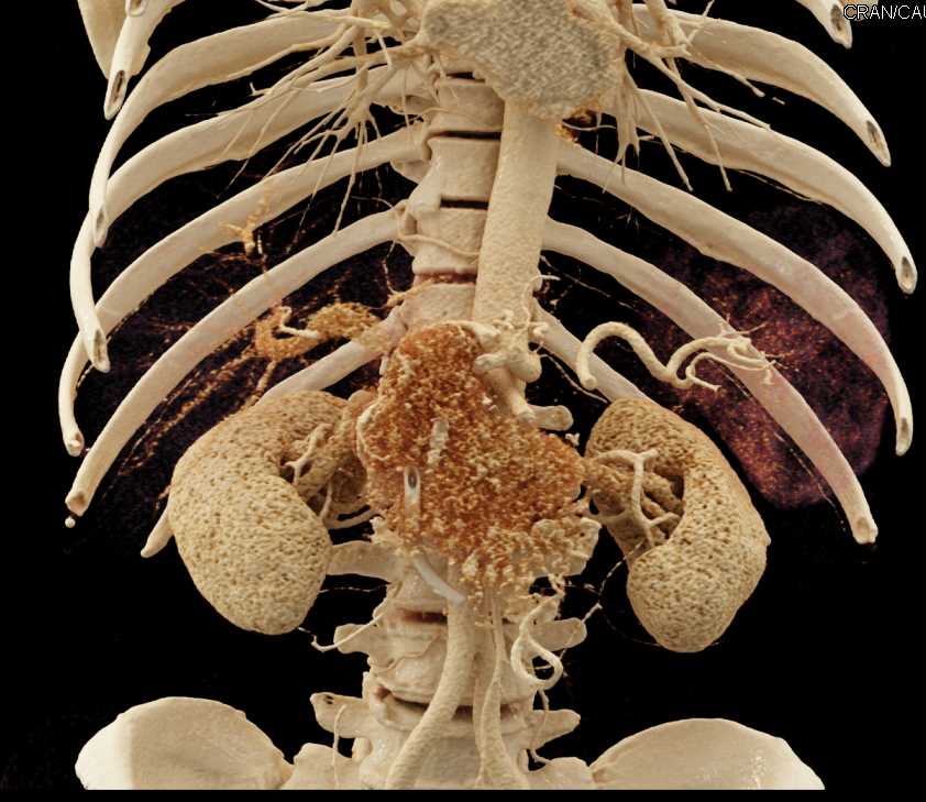 Neuroendocrine Tumor Head of Pancreas with Cinematic Rendering - CTisus CT Scan