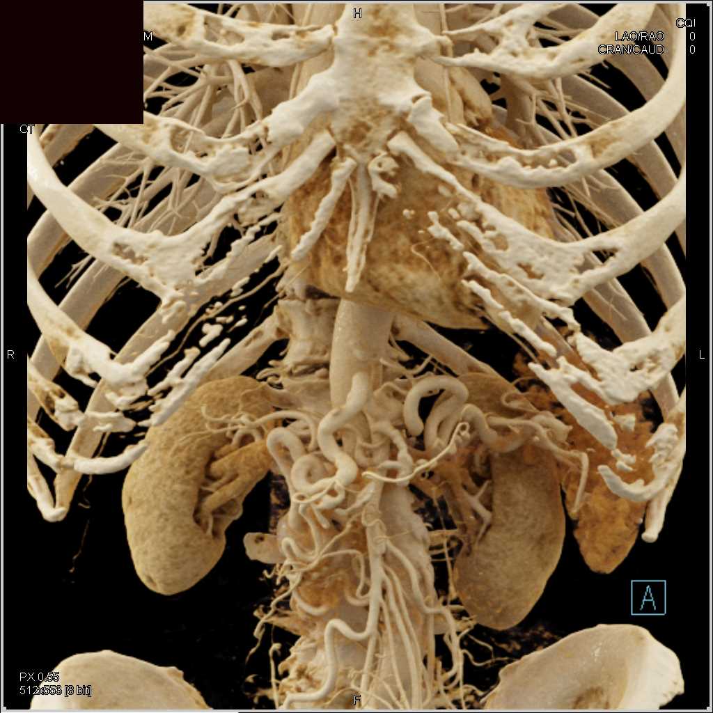 Vascular Mapping with Collaterals for Pancreatic Cancer - CTisus CT Scan