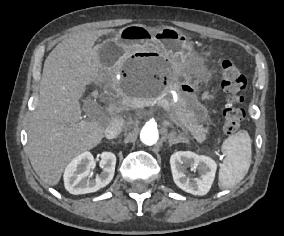 Pancreatic Abscess - CTisus CT Scan