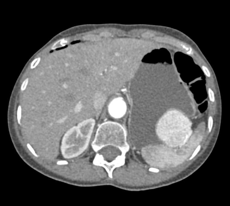 Neuroendocrine Tumor Tail of Pancreas - CTisus CT Scan