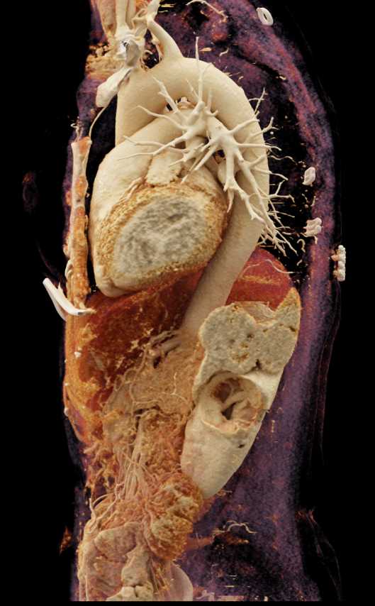 Neuroendocrine Tumor Tail of Pancreas with Cinematic Rendering - CTisus CT Scan