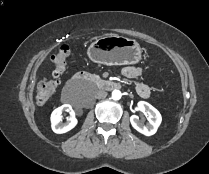 Oligocystic Serous Cystadenoma - CTisus CT Scan