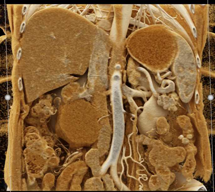 Oligocystic Serous Cystadenoma with Cinematic Rendering - CTisus CT Scan