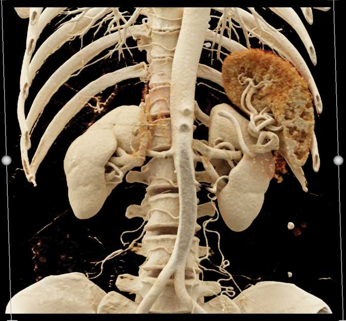 Oligocystic Serous Cystadenoma with Cinematic Rendering - CTisus CT Scan