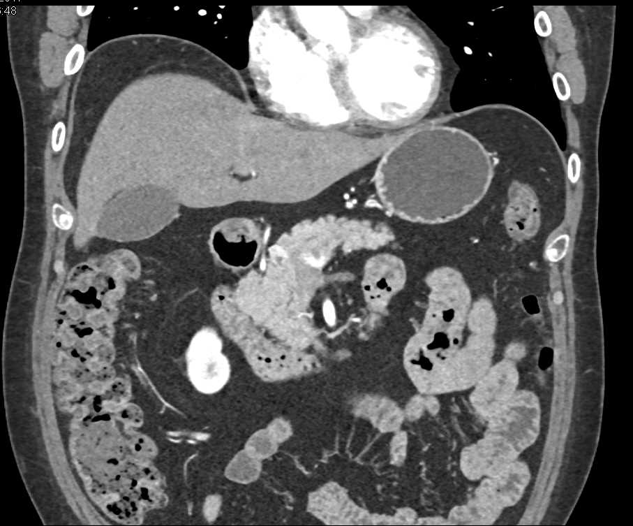 Small Neuroendocrine Tumors Pancreas - CTisus CT Scan