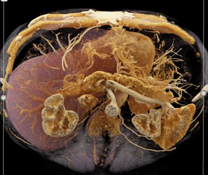 Pancreas Adenocarcinoma with Cinematic Rendering - CTisus CT Scan