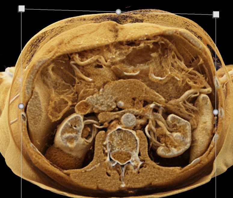 Infiltrating Carcinoma of the Body of the Pancreas - CTisus CT Scan