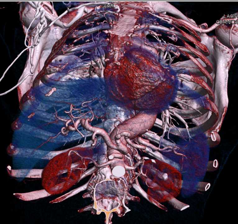 Infiltrating Carcinoma of the Body of the Pancreas - CTisus CT Scan