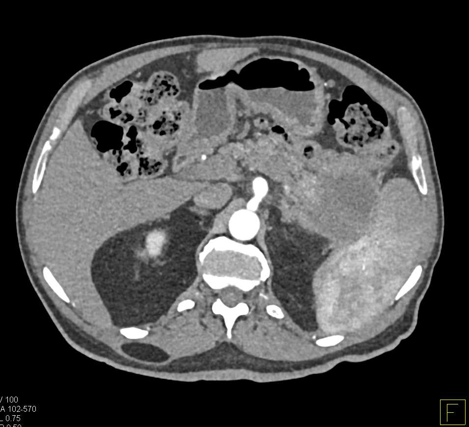 Carcinoma Tail of the Pancreas - CTisus CT Scan