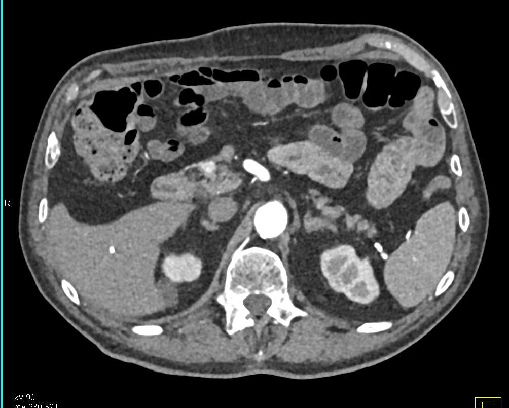 Pancreatic Neuroendocrine Tumor (PNET) Head of Pancreas - CTisus CT Scan