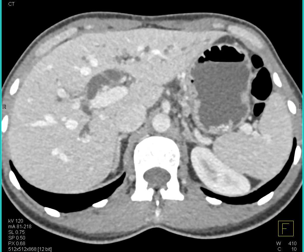 Carcinoma of the Pancreatic Head with Dilated Common Duct and Pancreatic Duct - CTisus CT Scan