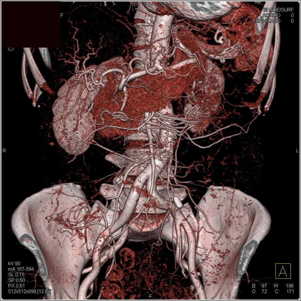 Normal Pancreas in 3D - CTisus CT Scan