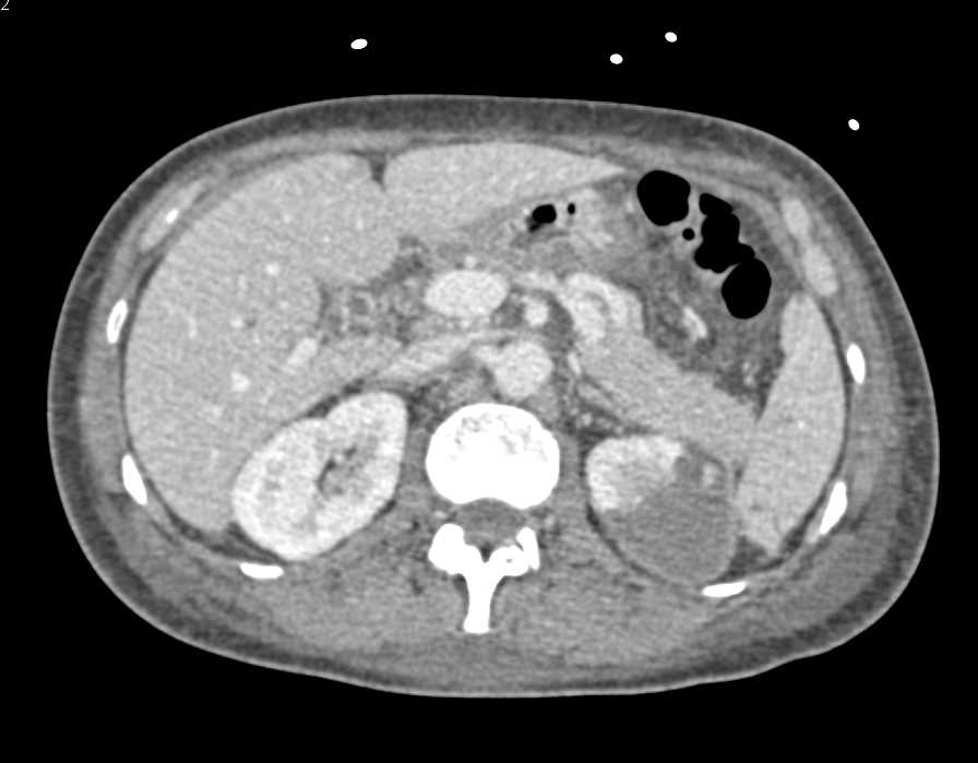 Carcinoma Tail of the Pancreas and Left Renal Infarction - CTisus CT Scan