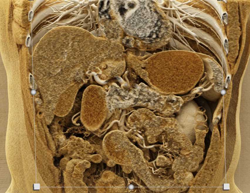 Neuroendocrine Tumor Tail of the Pancreas - CTisus CT Scan