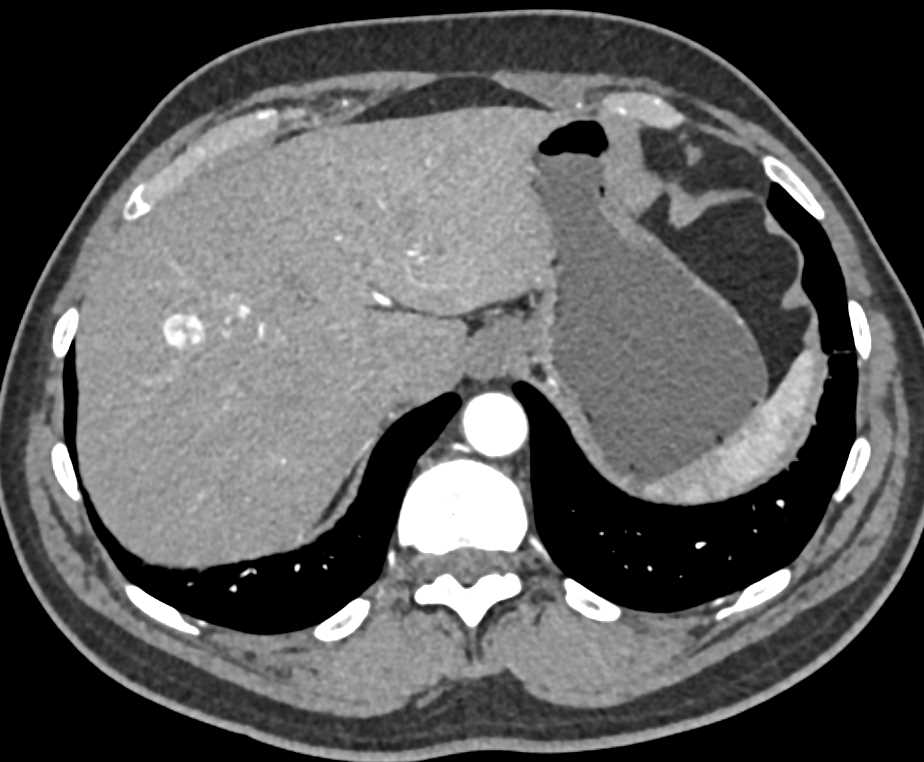 Neuroendocrine Tumor Tail of the Pancreas with Liver Metastases - CTisus CT Scan