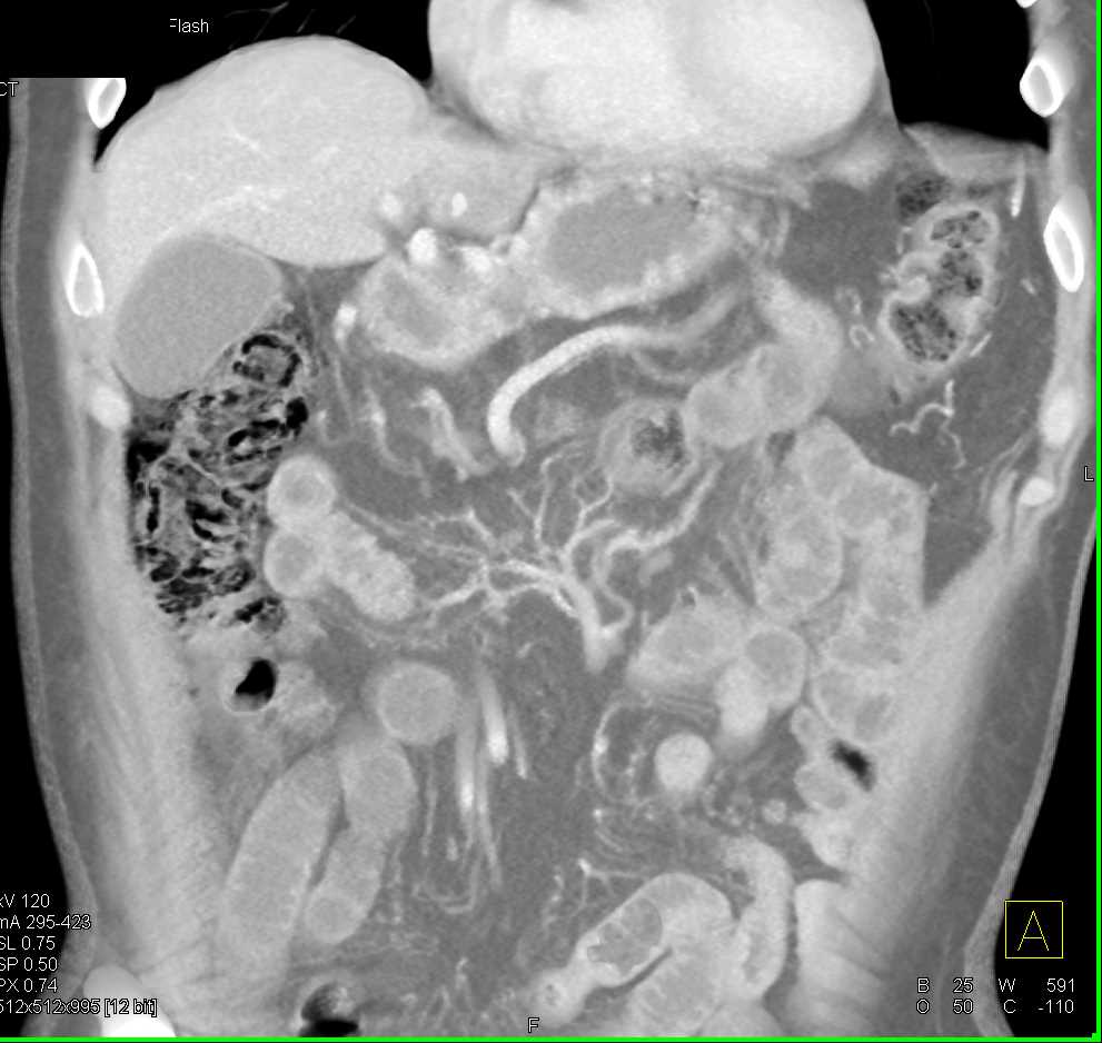 Pancreatic Adenocarcinoma and Pneumatosis - CTisus CT Scan