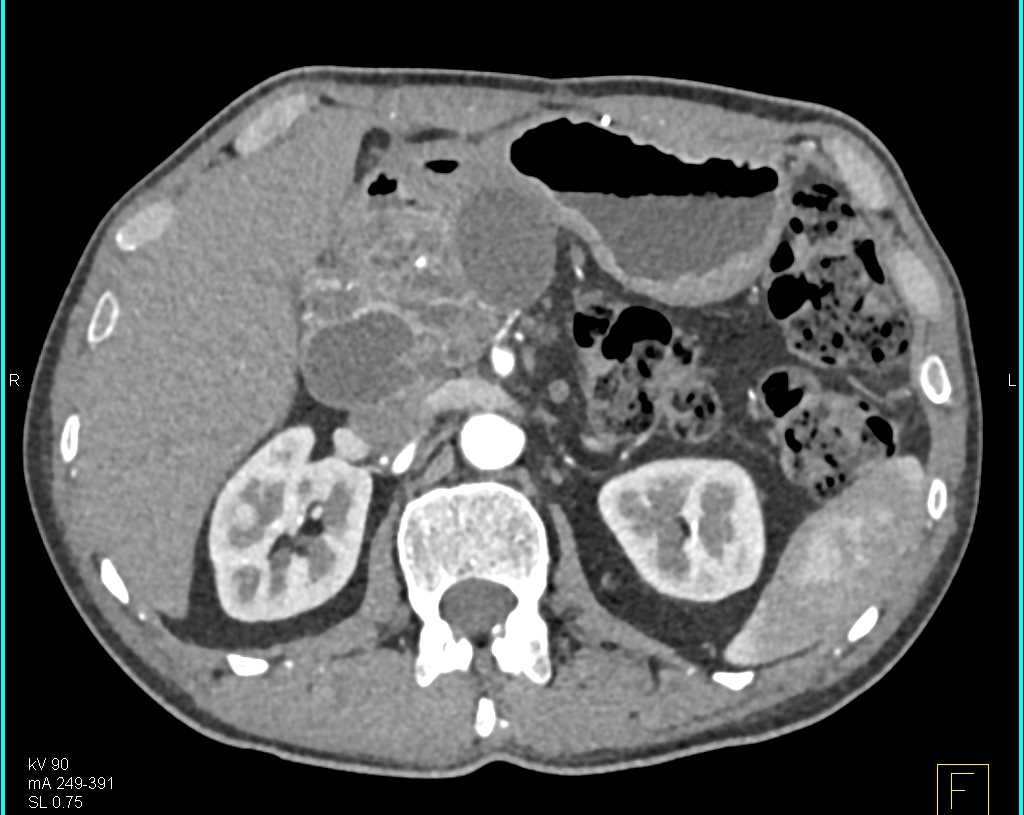 Multiple Intraductal Papillary Mucinous Neoplasms (IPMNs) in the Head of the Pancreas - CTisus CT Scan