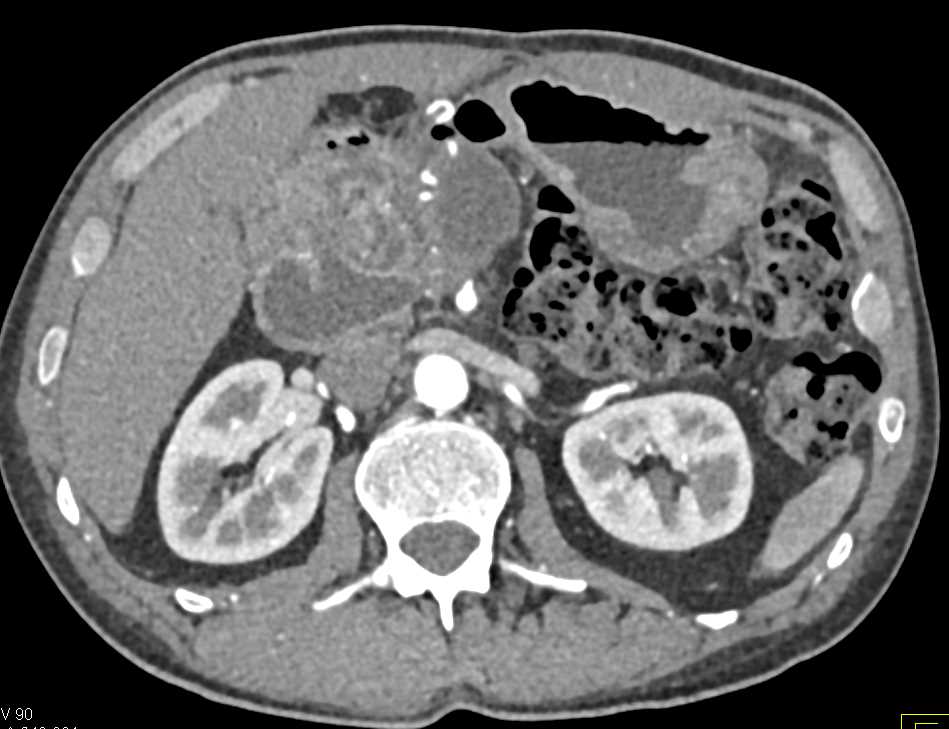 Multiple Intraductal Papillary Mucinous Neoplasms (IPMNs) in the Head of the Pancreas - CTisus CT Scan