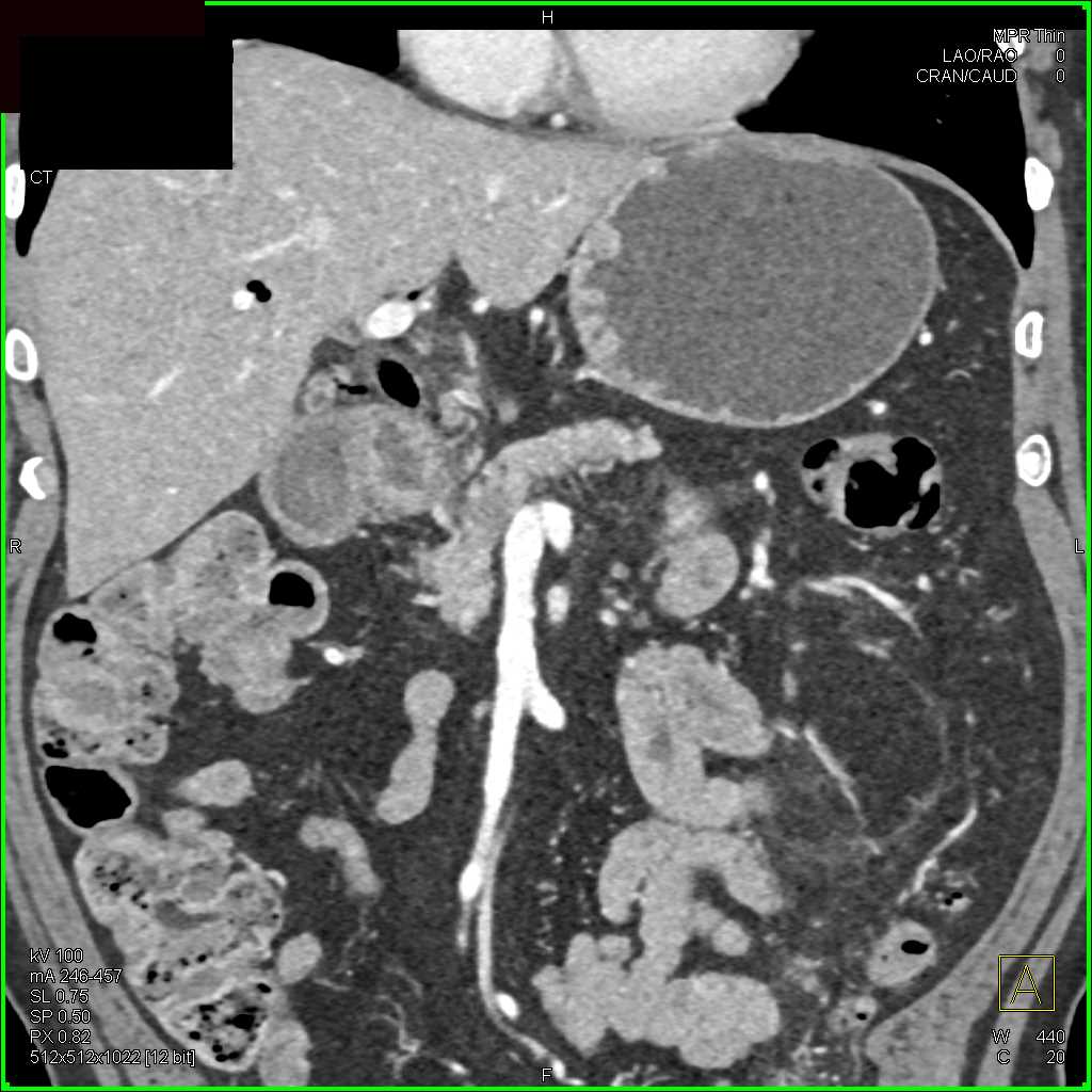 Carcinoma Head of Pancreas - CTisus CT Scan