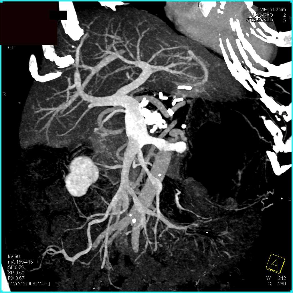 Neuroendocrine Tumor Pancreas - CTisus CT Scan