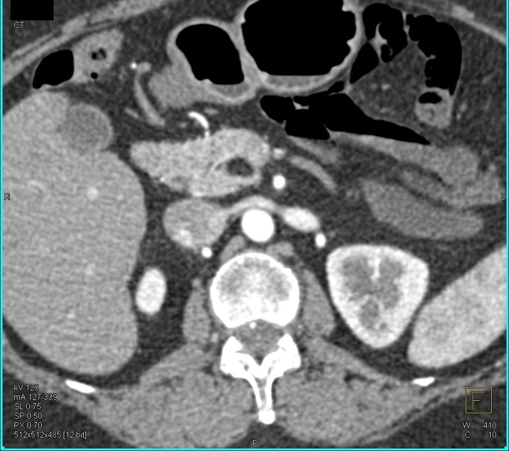 Lipoma Head of the Pancreas - CTisus CT Scan