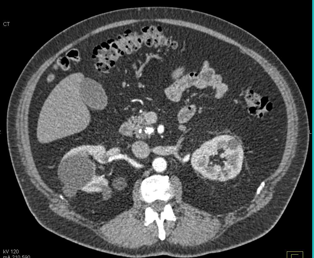 Chronic Pancreatitis - CTisus CT Scan