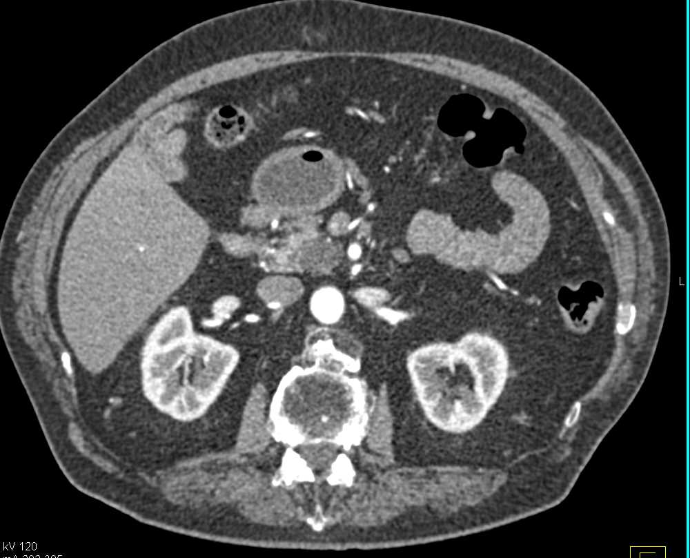 Intraductal Papillary Mucinous Neoplasm (IPMN) Head of Pancreas - CTisus CT Scan